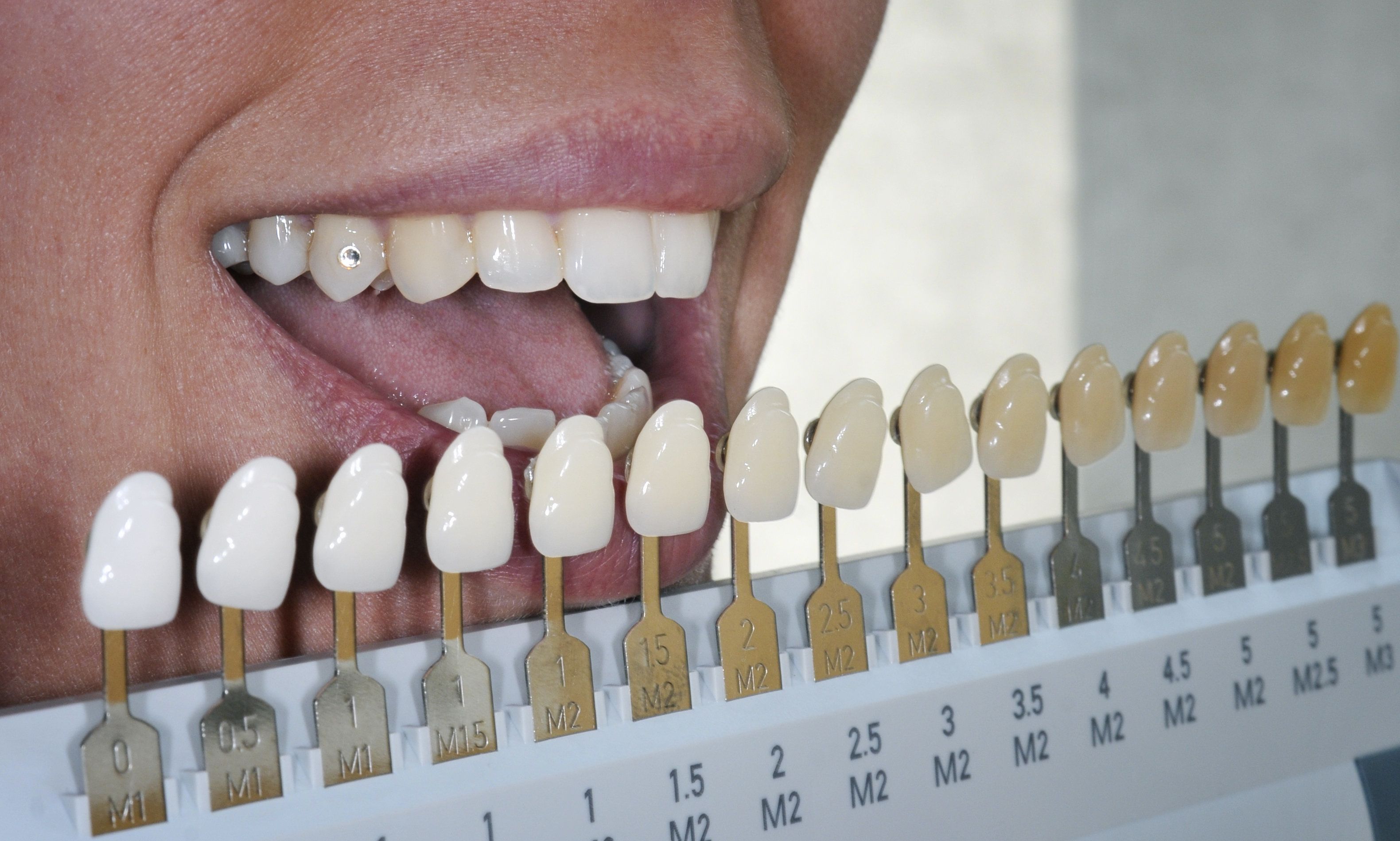 Photo of dental shade guide held up to a mouth