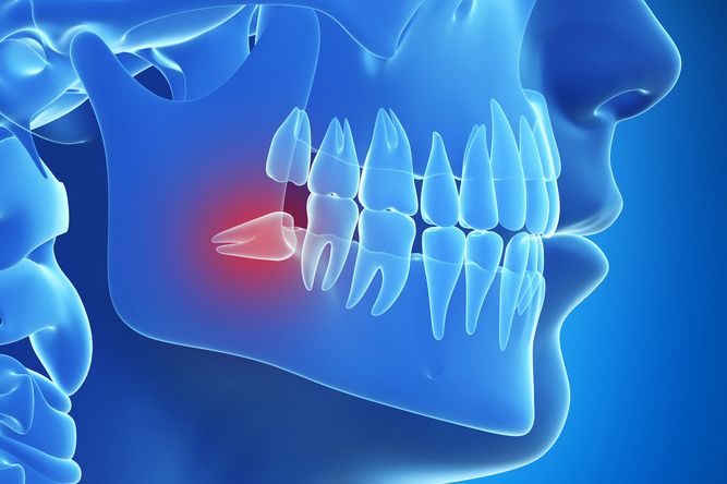 Graphic illustrating how an impacted tooth can damage surrounding molars
