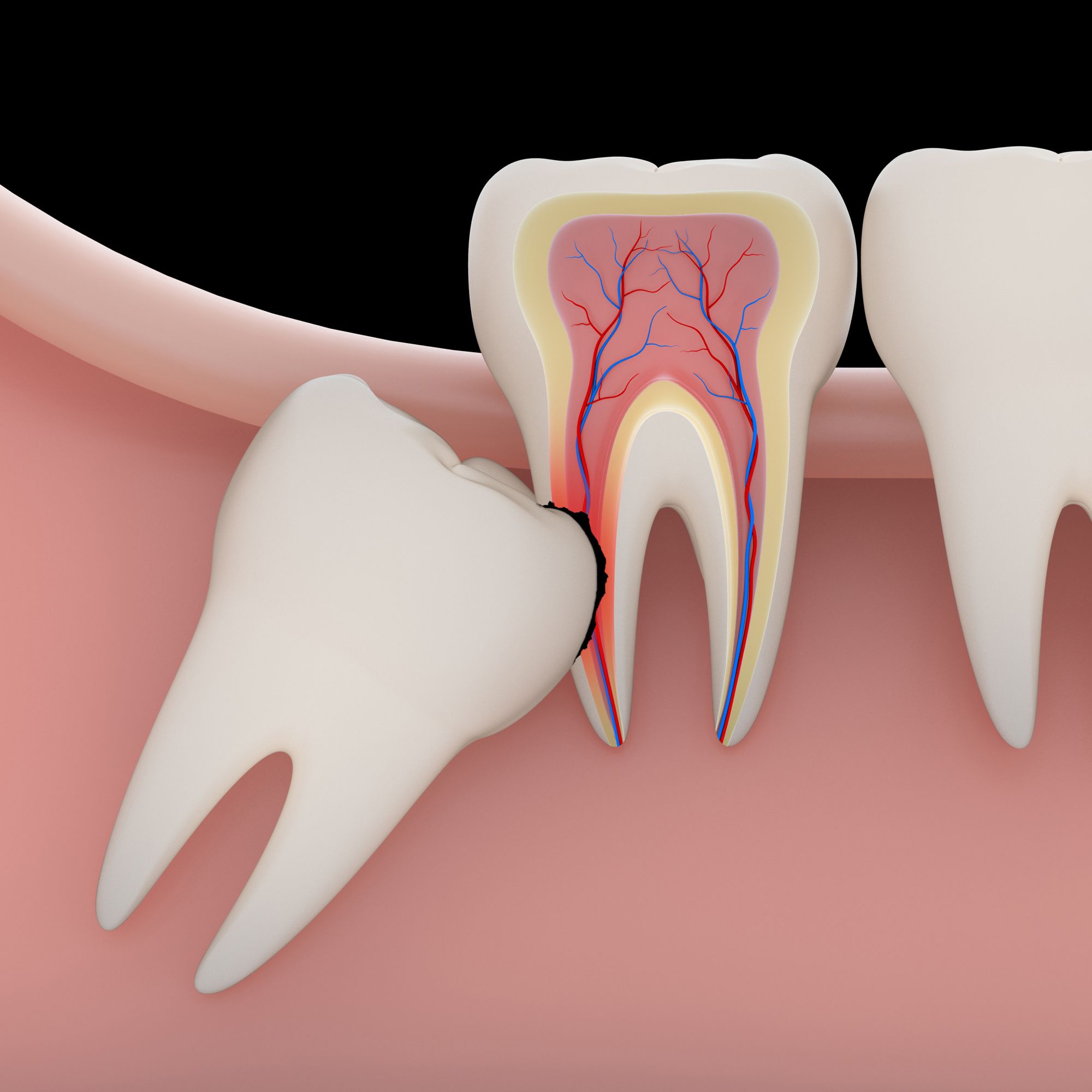 Illustration of a tooth growing into another tooth