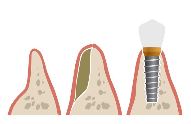 illustration of a bone graft