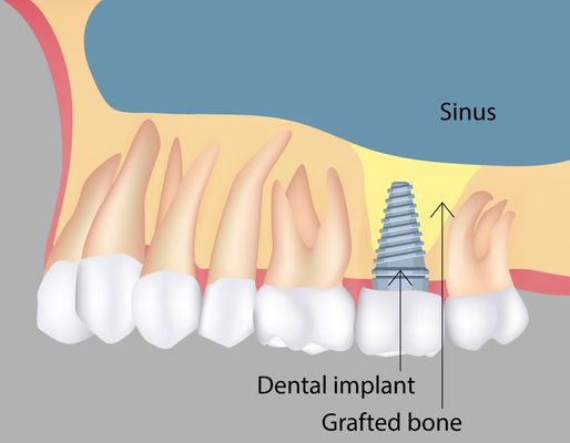 illustration of sinus lift