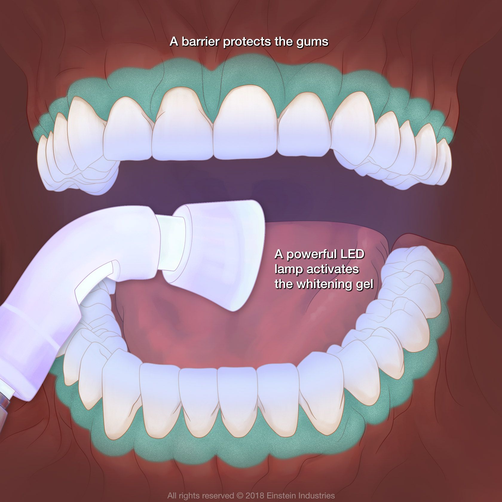 A barrier protects the gums. A powerful LED lamp activates the whitening gel