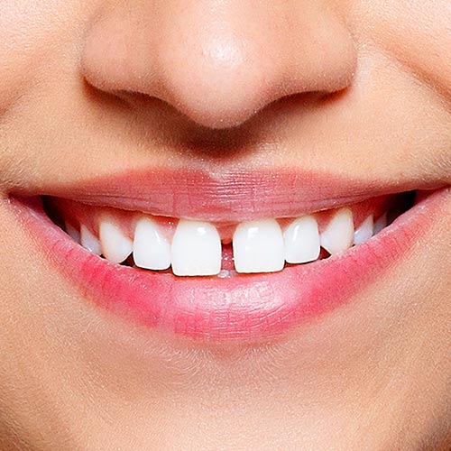 Woman's gapped front teeth