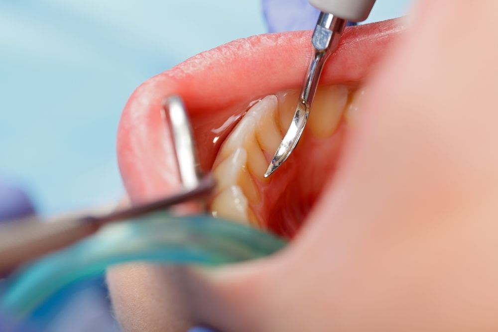 Photo of a patient receiving scaling and root planing